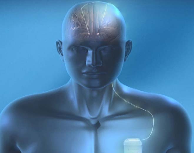 Brain implant device for neurological treatment
