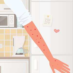 valentines-day-emergencies-06 Severe allergic reactions